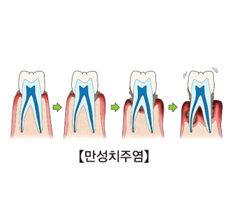 [진주치과/진주임플란트치과] 그람음성간균에 대해 아시나요? - 진주 우리들치과병원