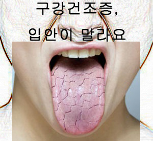 [진주치과/진주임플란트] 구강건조증, 입안이 마르는 것 같아요 - 진주 우리들치과병원
