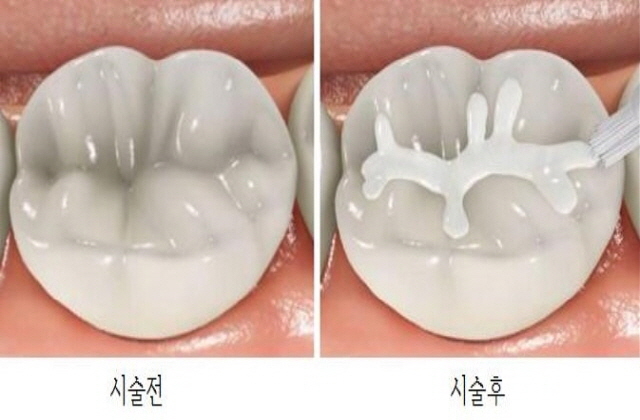 [진주치과,진주임플란트치과] 소아, 청소년을 위한 치아 홈메우기 건강보험 혜택에 대해 알려드립니다. - 진주 우리들치과병원